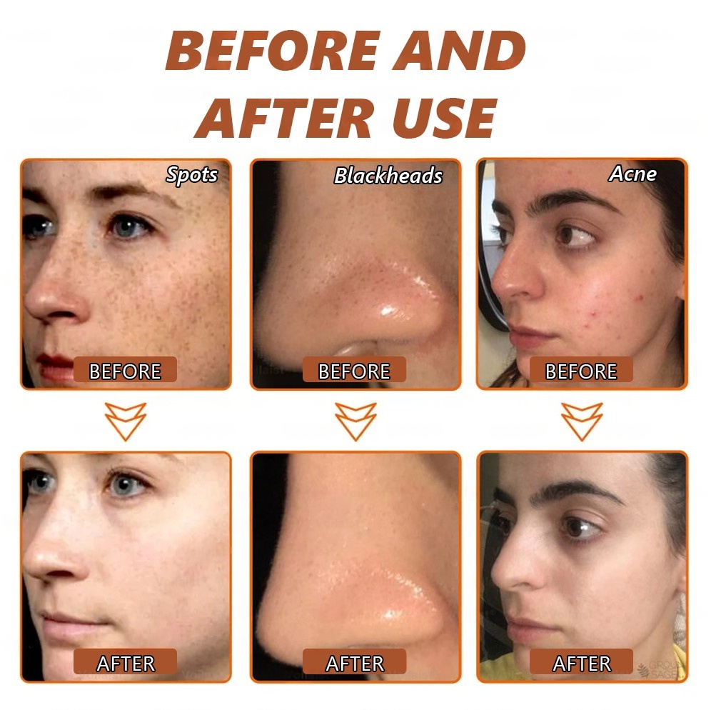 šµļø Zakdavi⢠Radiant Whitening & Spot Eraser MaskāØ| For Face and Body - Formulated with natural ingredients to permanently eliminate age spots, freckles, sun spots, and liver spots.