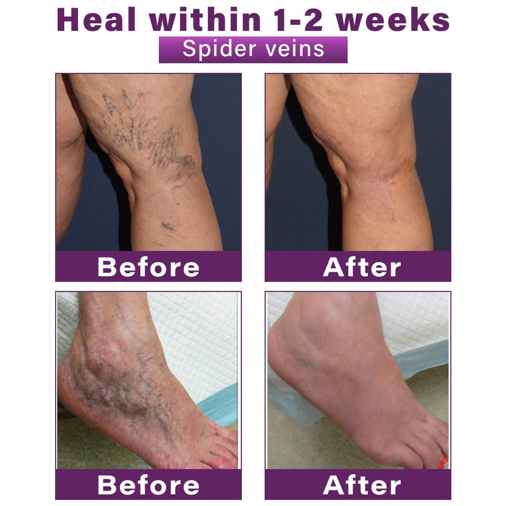 Seurico™ Polidocanol Nano Varicose Vein Relief Patch 👩🏼⚕️ Clinically Recommended by NICE (National Institute for Health and Care Excellence)