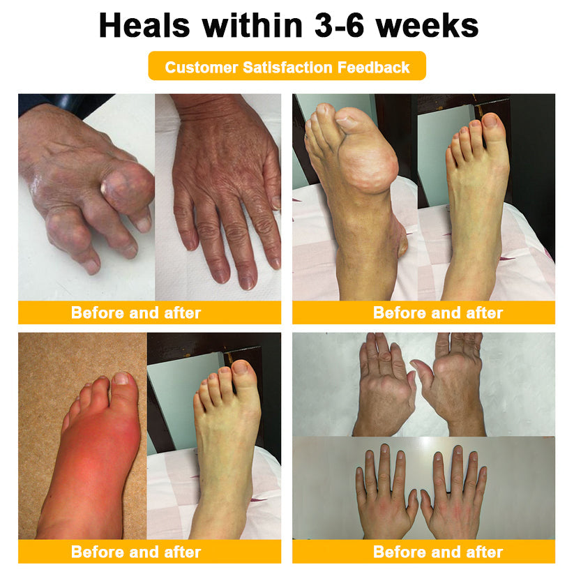 🎁Flash Sale - Odeiun™ Botulinum Toxin & Bee Venom Pain-Relief Bone Healing Cream