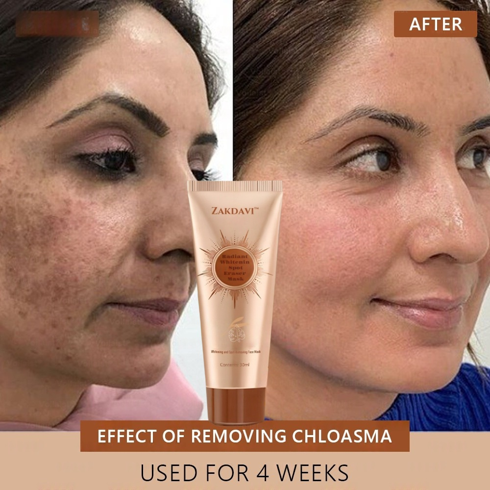 šµļø Zakdavi⢠Radiant Whitening & Spot Eraser MaskāØ| For Face and Body - Formulated with natural ingredients to permanently eliminate age spots, freckles, sun spots, and liver spots.