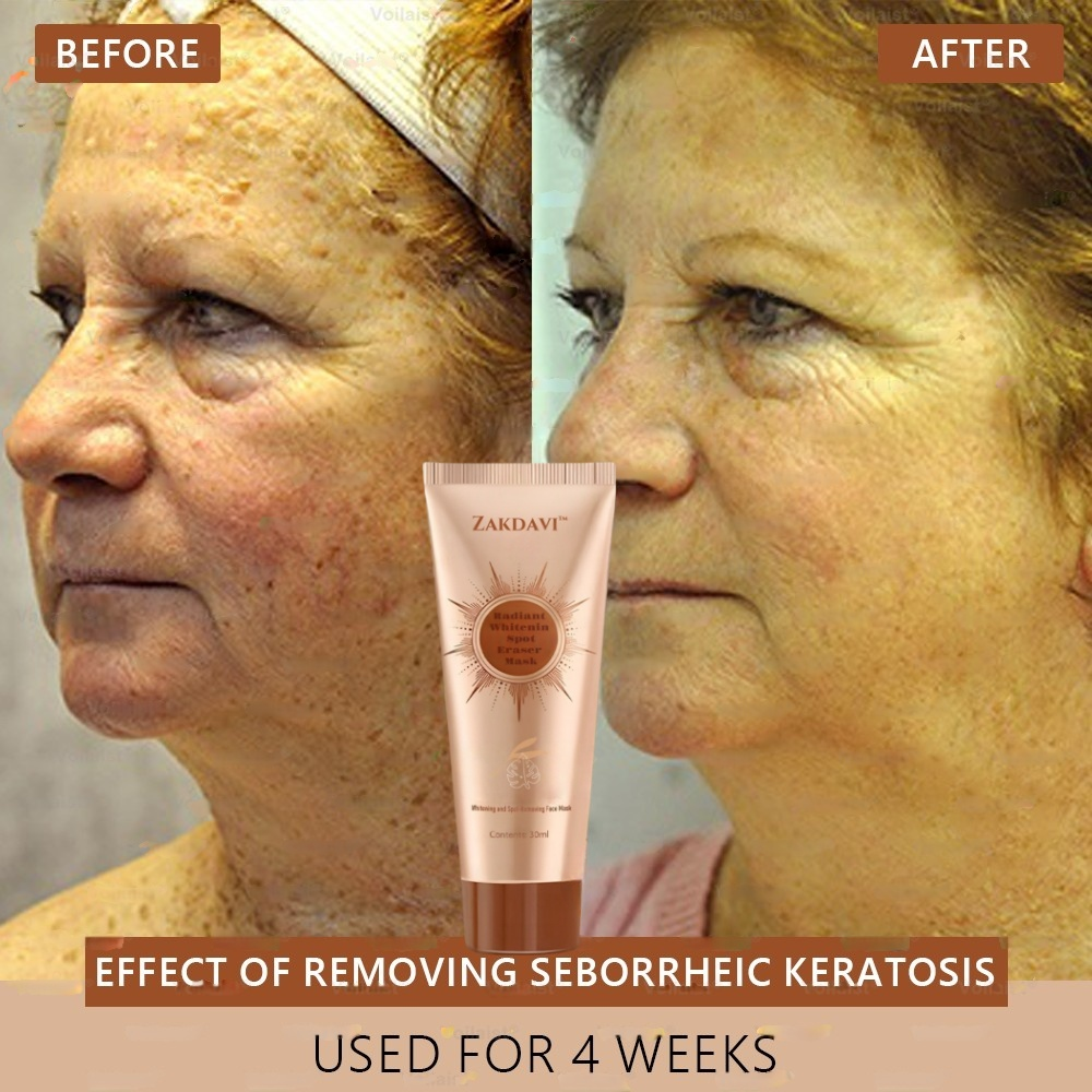 šµļø Zakdavi⢠Radiant Whitening & Spot Eraser MaskāØ| For Face and Body - Formulated with natural ingredients to permanently eliminate age spots, freckles, sun spots, and liver spots.