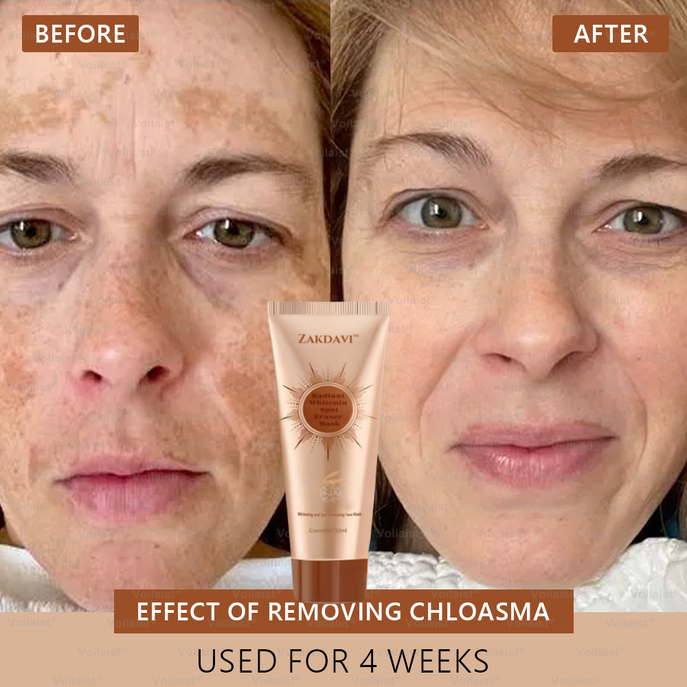 šµļø Zakdavi⢠Radiant Whitening & Spot Eraser MaskāØ| For Face and Body - Formulated with natural ingredients to permanently eliminate age spots, freckles, sun spots, and liver spots.