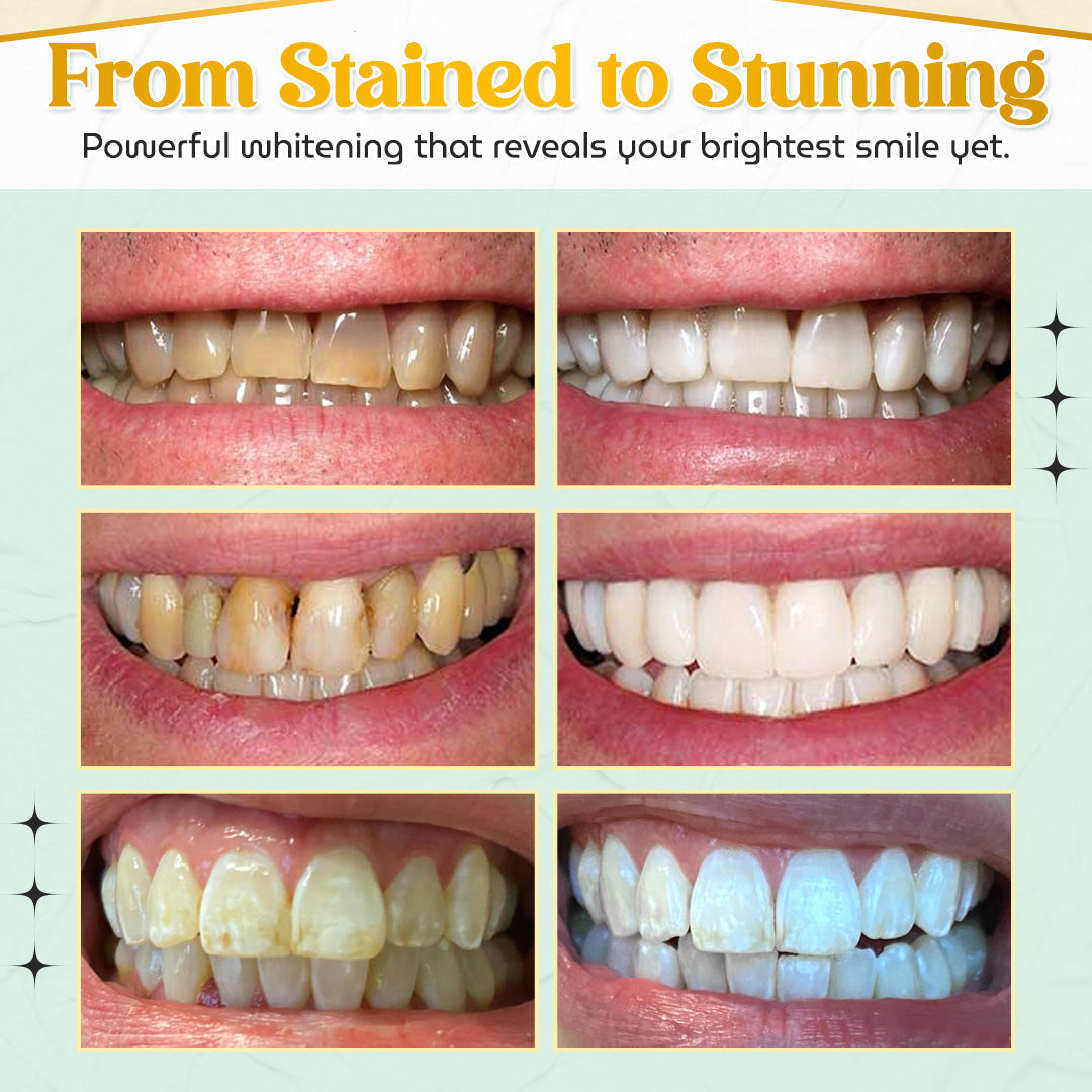 Seurico™ RadiantWhite Whitening Pen — Dual-Peroxide + Xylitol Formula-Brighter Smiles in Days — Anytime, Anywhere