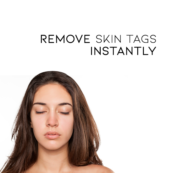Seurico™ WipeOff Tags & Mole Remover