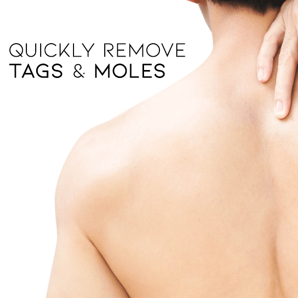 Seurico™ WipeOff Tags & Mole Remover