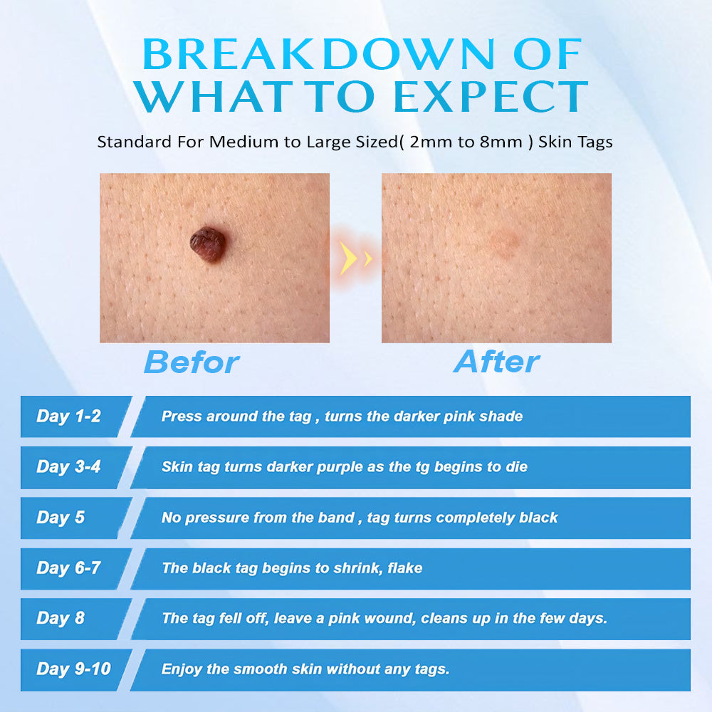 Seurico™ At-home Skin Tag Removal Pen