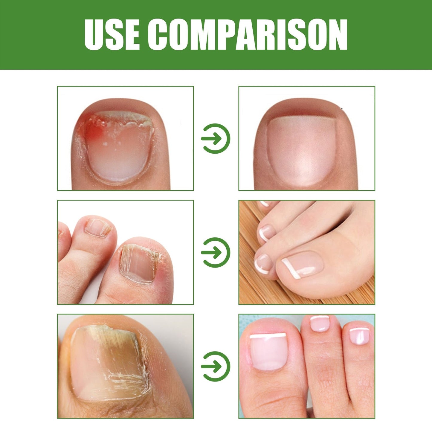🔥Seurico™ Fungal Inhibiting Stick |Say Goodbye to Nail Fungus in Just 5 Days!