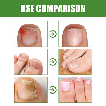 🔥Seurico™ Fungal Inhibiting Stick |Say Goodbye to Nail Fungus in Just 5 Days!