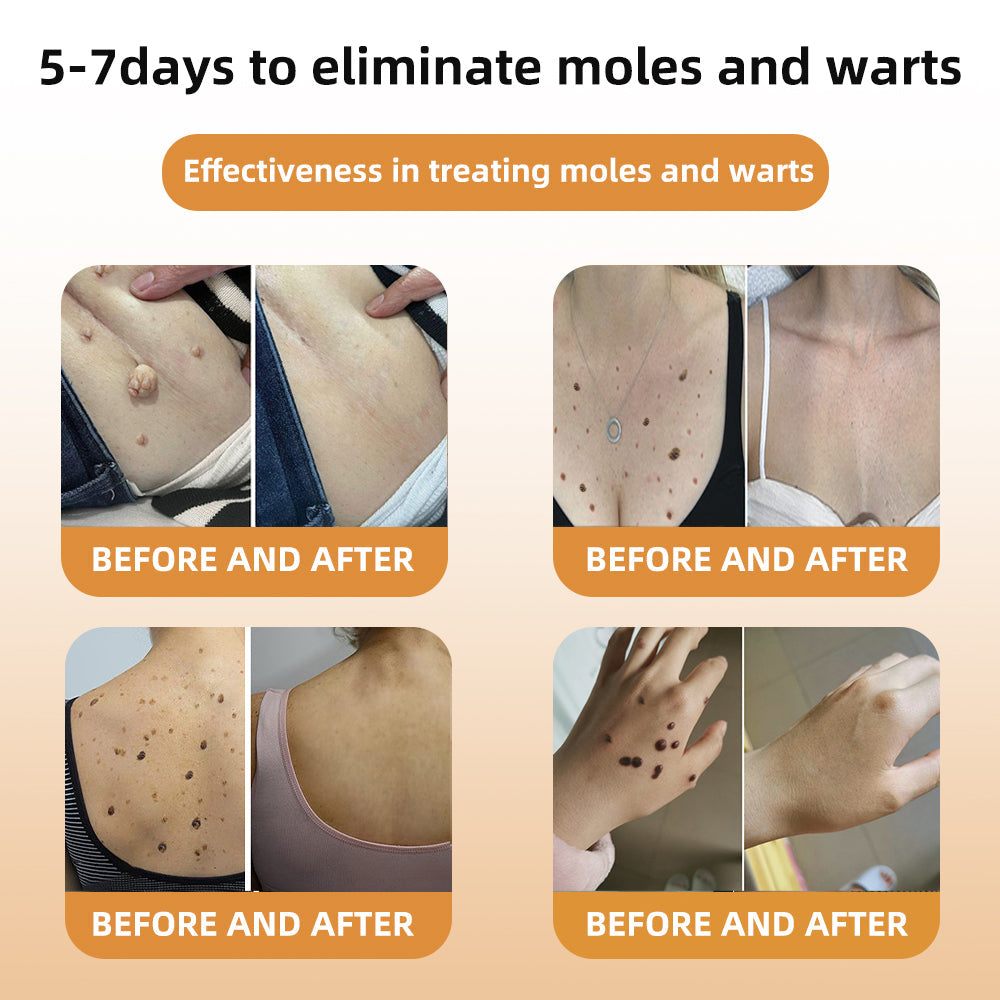 Honeybee Venom Mole and Wart Cream
