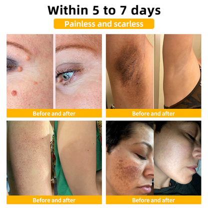 Honeybee Venom Mole and Wart Cream