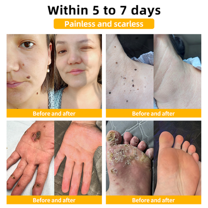 Honeybee Venom Mole and Wart Cream