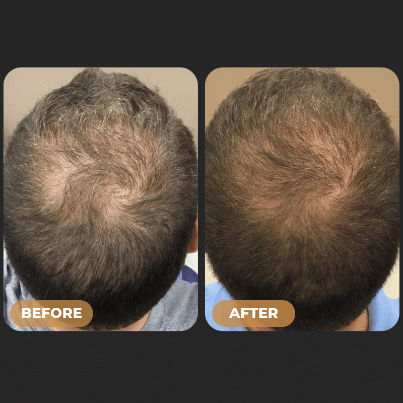 ODALIT™ Root Activator Shampoo - Increased Hair Growth with Just 4 Washes a Week