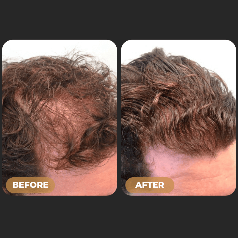 ODALIT™ Root Activator Shampoo - Increased Hair Growth with Just 4 Washes a Week