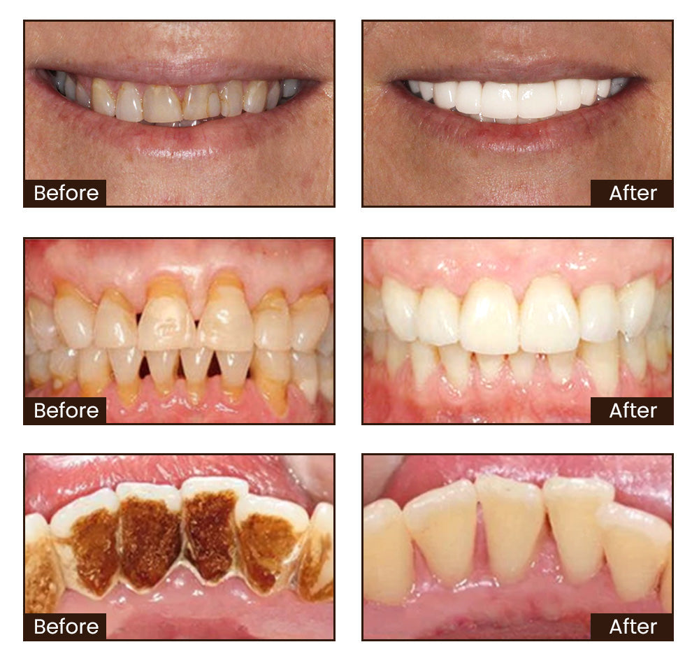 🦷 Seurico™ Niacinamide Whitening Toothpaste - Gentle on Gums, Designed for Sensitive Teeth, Reveals a Radiant, Healthy Smile