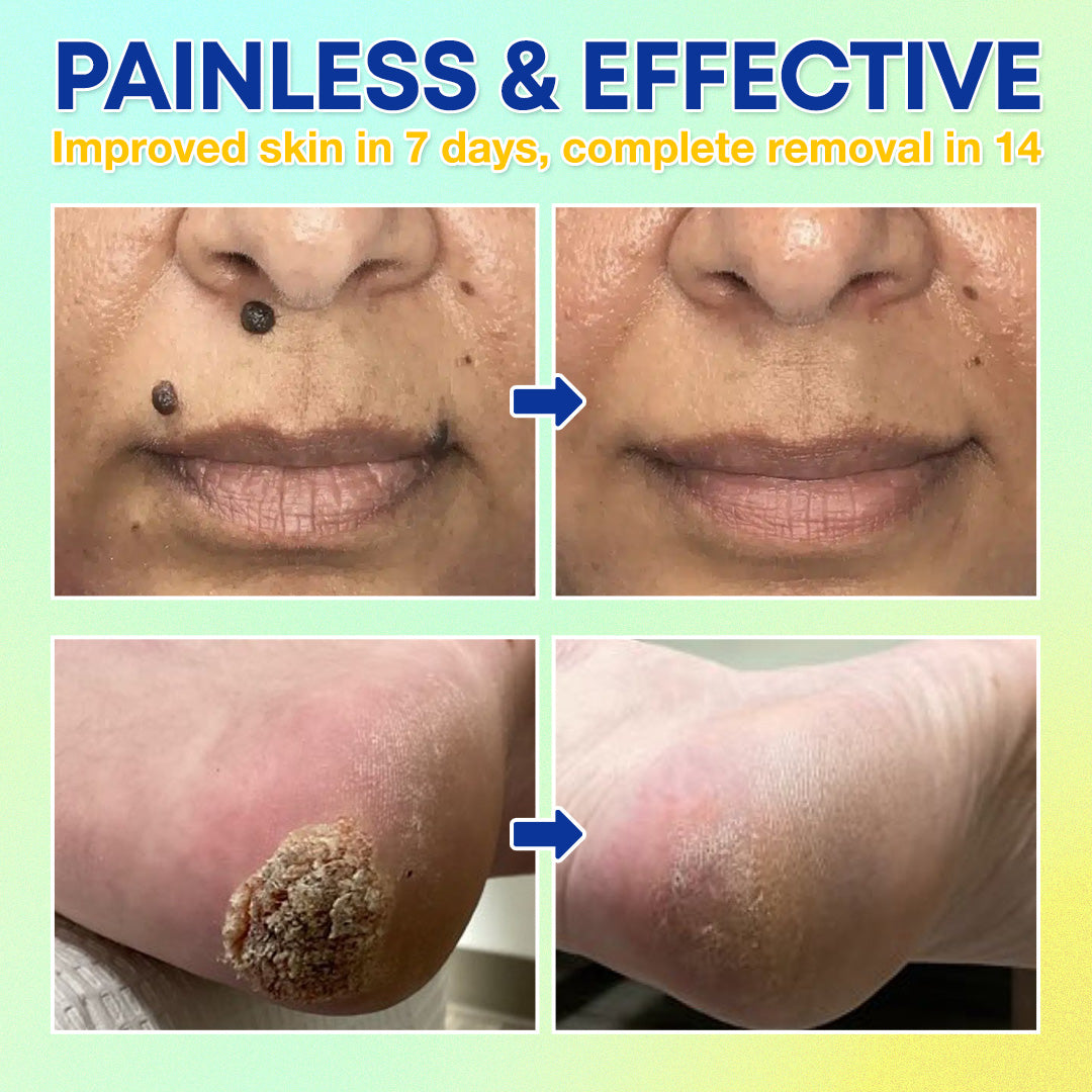 ❄️ LBMLBM™ Skin Tag Cryo Treatment Spray — Fast Freezing At-Home Removal ✨