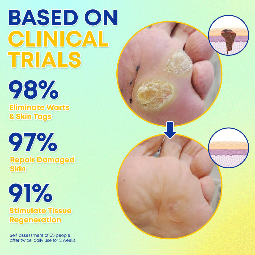 ❄️ LBMLBM™ Skin Tag Cryo Treatment Spray — Fast Freezing At-Home Removal ✨