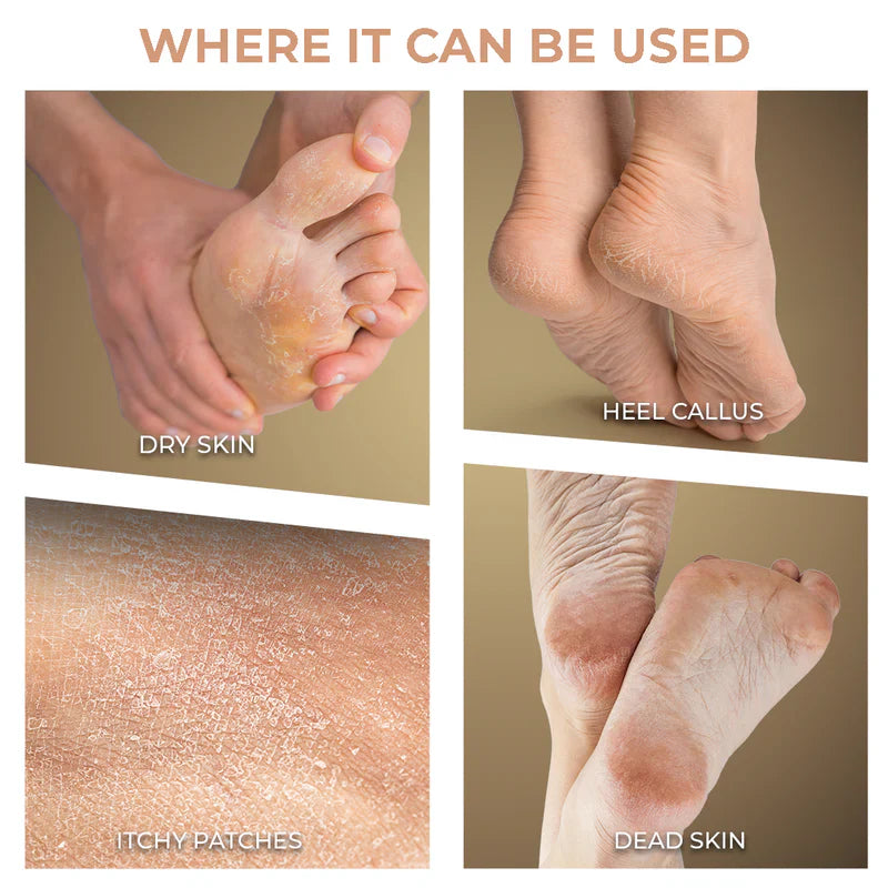 Seurico™Foot roller to remove calluses